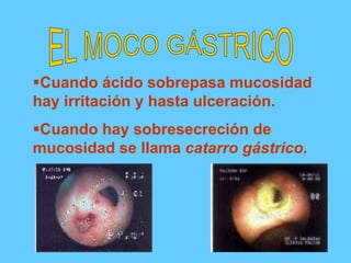 Cuando ácido sobrepasa mucosidad
hay irritación y hasta ulceración.
Cuando hay sobresecreción de
mucosidad se llama catarro gástrico.
 