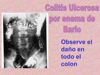 Observe el
daño en
todo el
colon
 