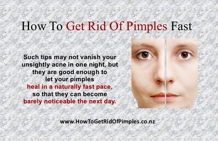 How To Get Rid Of Pimples Naturally In One Day How To Get Rid Of Pimples Naturally In One Day
