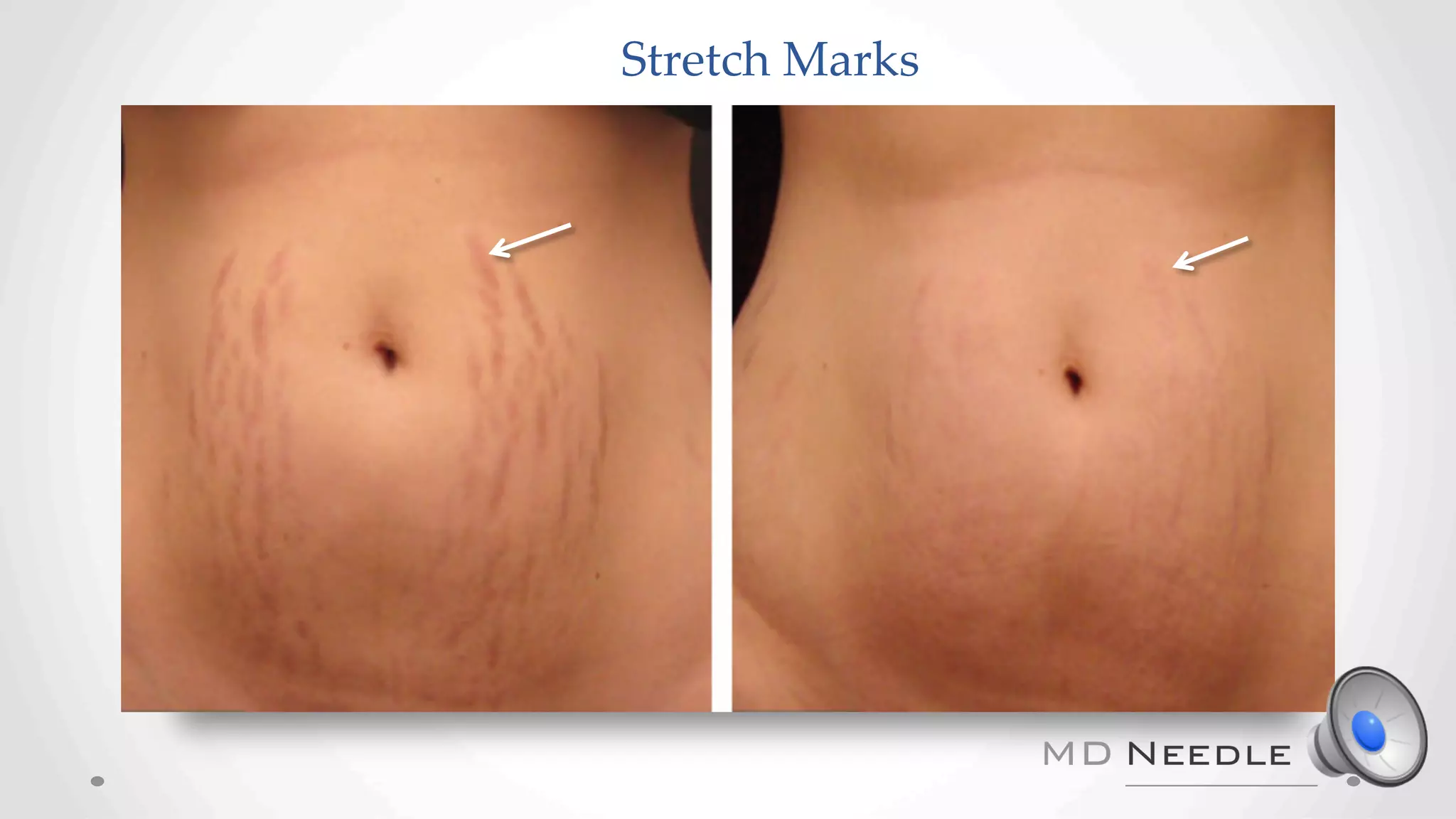 Stretch Marks