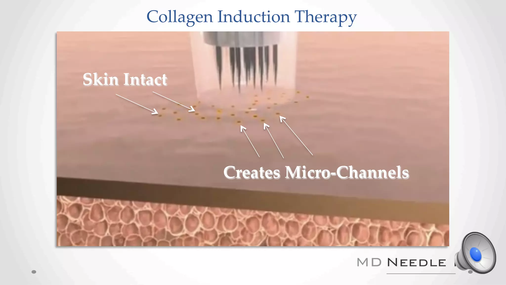 Creates Micro-Channels
Collagen Induction Therapy
Skin Intact