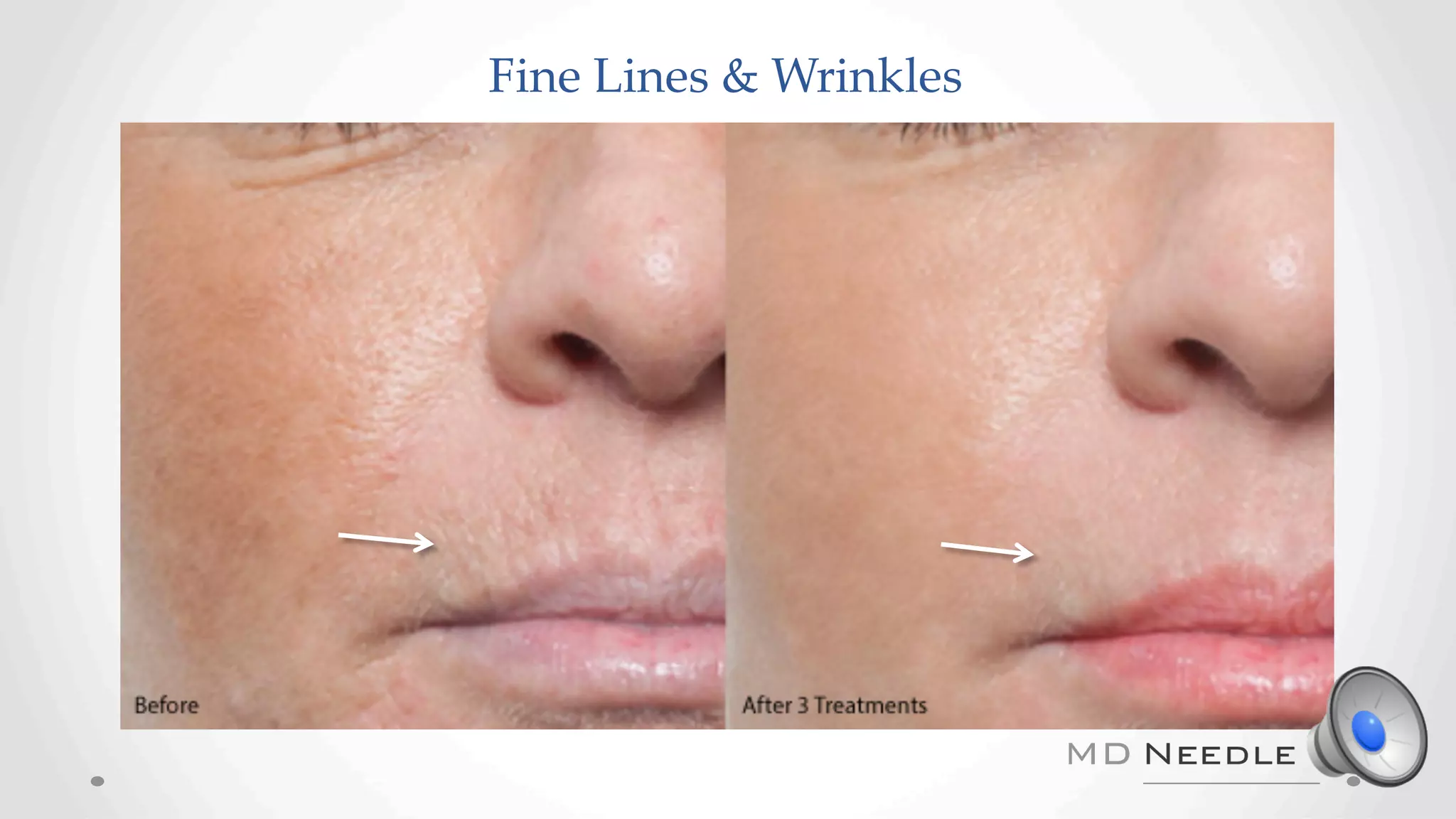 Fine Lines & Wrinkles