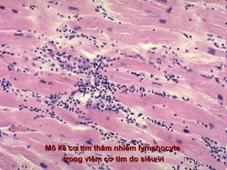 Mô kẽ cơ tim thâm nhiễm lymphocyteMô kẽ cơ tim thâm nhiễm lymphocyte
trong viêm cơ tim do siêu vitrong viêm cơ tim do siêu vi
 