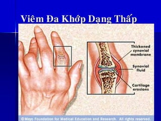 Vieâm Ña Khôùp Daïng Thaáp
 
