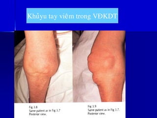 Khuûyu tay vieâm trong VÑKDT
 