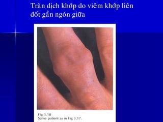 Traøn dòch khôùp do vieâm khôùp lieân
ñoát gaàn ngoùn giöõa
 