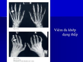 Vieâm ña khôùp
daïng thaáp
 