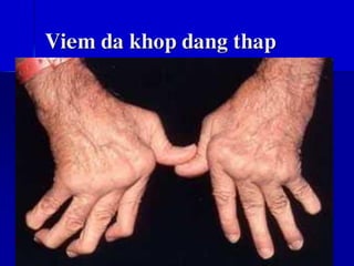 Viem da khop dang thap
 
