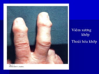 Vieâm xöông
khôùp
Thoaùi hoùa khôùp
 