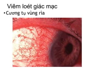 Viêm loét giác mạc
•Cương tụ vùng rìa
 