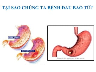 TẠI SAO CHÚNG TA BỆNH ĐAU BAO TỬ?
 