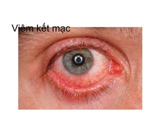 Viêm kết mạc
 