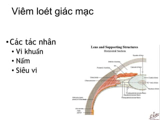 Viêm loét giác mạc
•Các tác nhân
• Vi khuẩn
• Nấm
• Siêu vi
 