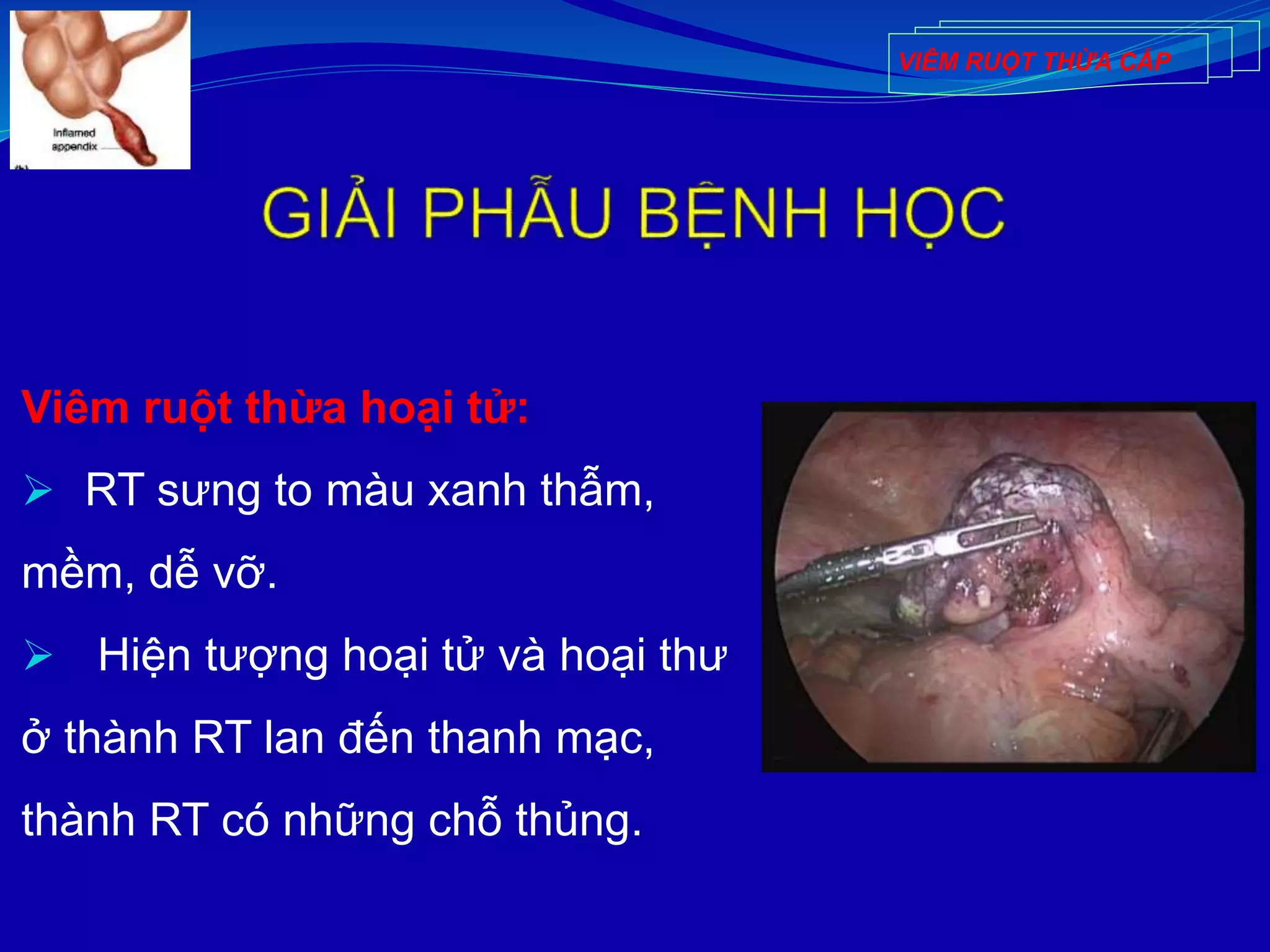 Viêm ruột thừa hoại tử:
 RT sưng to màu xanh thẫm,
mềm, dễ vỡ.
 Hiện tượng hoại tử và hoại thư
ở thành RT lan đến thanh mạc,
thành RT có những chỗ thủng.
VIÊM RUỘT THỪA CẤP
 