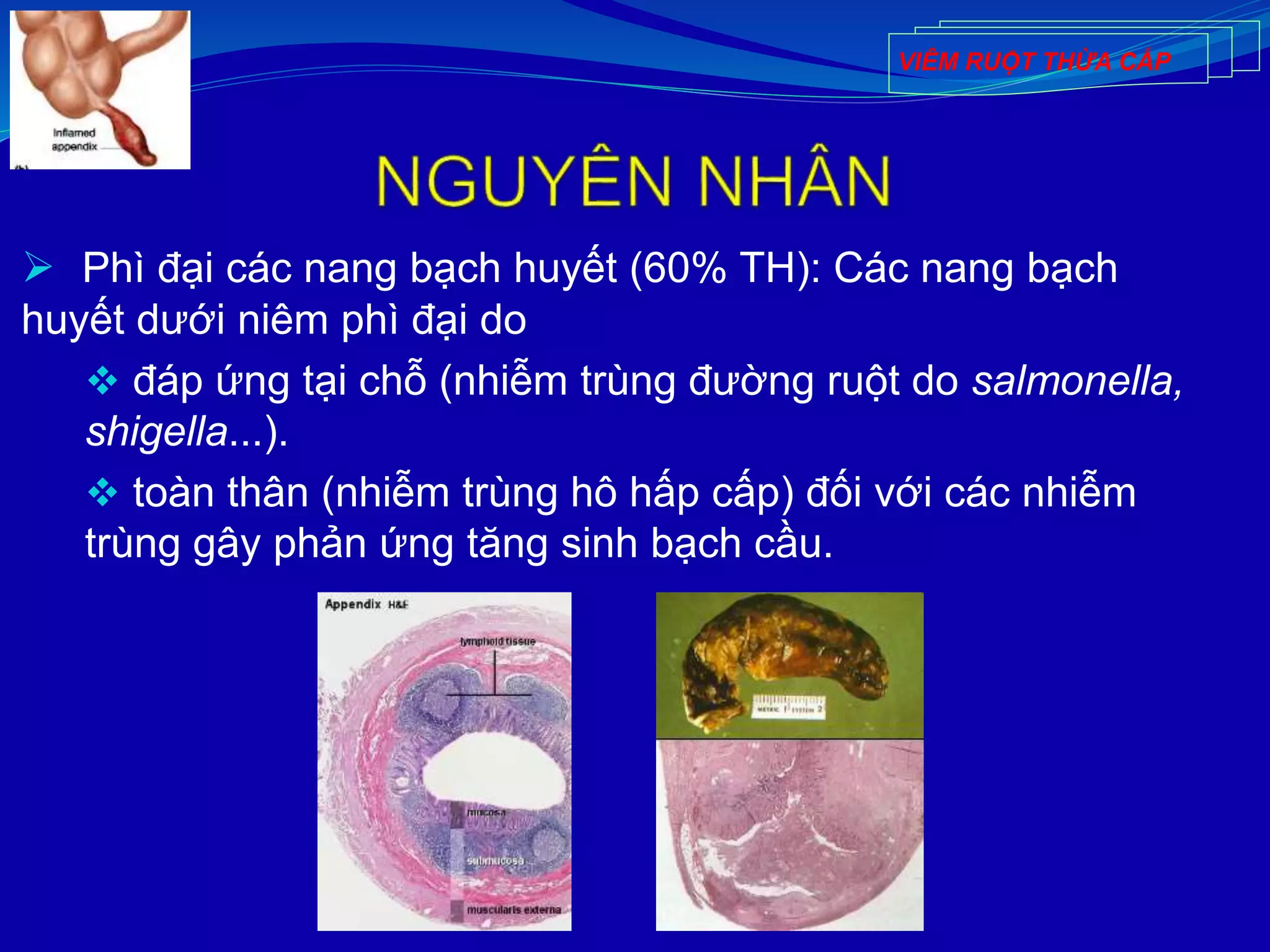  Phì đại các nang bạch huyết (60% TH): Các nang bạch
huyết dưới niêm phì đại do
 đáp ứng tại chỗ (nhiễm trùng đường ruột do salmonella,
shigella...).
 toàn thân (nhiễm trùng hô hấp cấp) đối với các nhiễm
trùng gây phản ứng tăng sinh bạch cầu.
VIÊM RUỘT THỪA CẤP
 