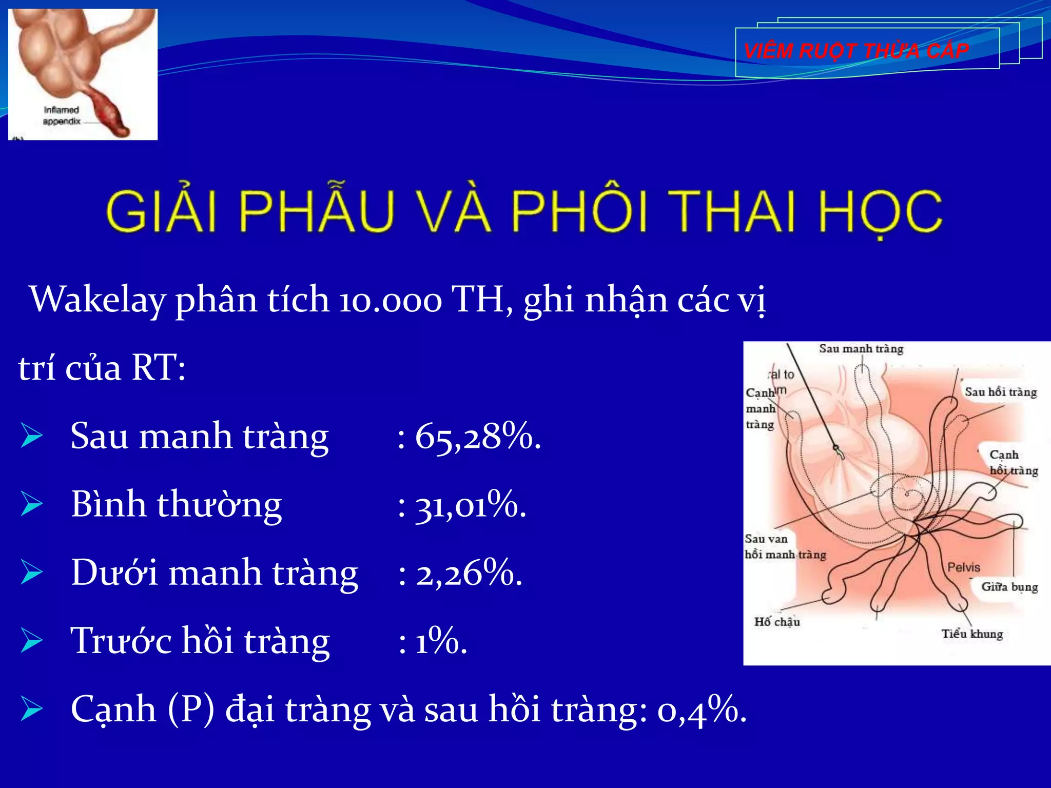 Wakelay phân tích 10.000 TH, ghi nhận các vị
trí của RT:
 Sau manh tràng : 65,28%.
 Bình thường : 31,01%.
 Dưới manh tràng : 2,26%.
 Trước hồi tràng : 1%.
 Cạnh (P) đại tràng và sau hồi tràng: 0,4%.
VIÊM RUỘT THỪA CẤP
 