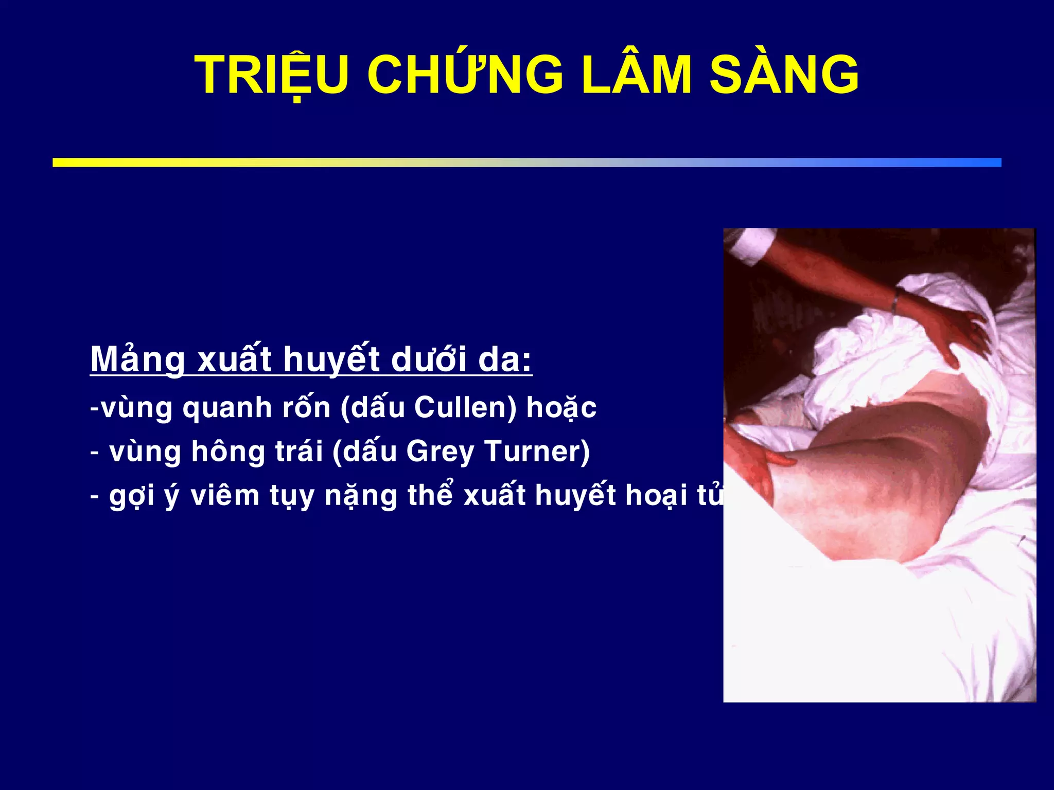 Maûng xuaát huyeát döôùi da:
-vuøng quanh roán (daáu Cullen) hoaëc
- vuøng hoâng traùi (daáu Grey Turner)
- gôïi yù vieâm tuïy naëng theå xuaát huyeát hoaïi töû.
TRIỆU CHỨNG LÂM SÀNG
 