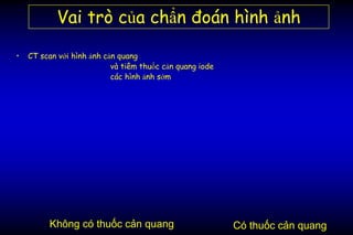 Vai trò của chẩn đoán hình ảnh
• CT scan với hình ảnh cản quang
và tiêm thuốc cản quang iode
các hình ảnh sớm
Có thuốc cản quangKhông có thuốc cản quang
 