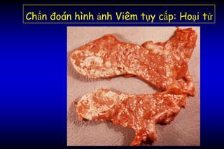 Chẩn đoán hình ảnh Viêm tụy cấp: Hoại tử
 
