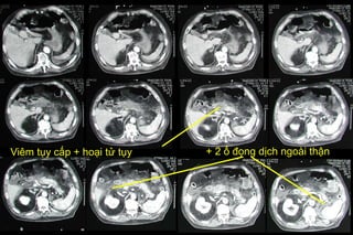 Viêm tụy cấp + hoại tử tụy + 2 ổ đọng dịch ngoài thận
 