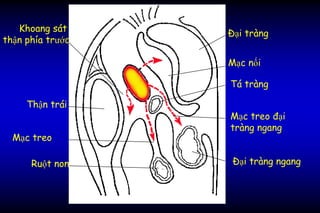 Đại tràng
Mạc nối
Tá tràng
Mạc treo
Mạc treo đại
tràng ngang
Ruột non Đại tràng ngang
Khoang sát
thận phía trước
Thận trái
 