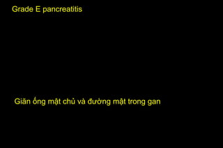 Grade E pancreatitis
Giãn ống mật chủ và đường mật trong gan
 