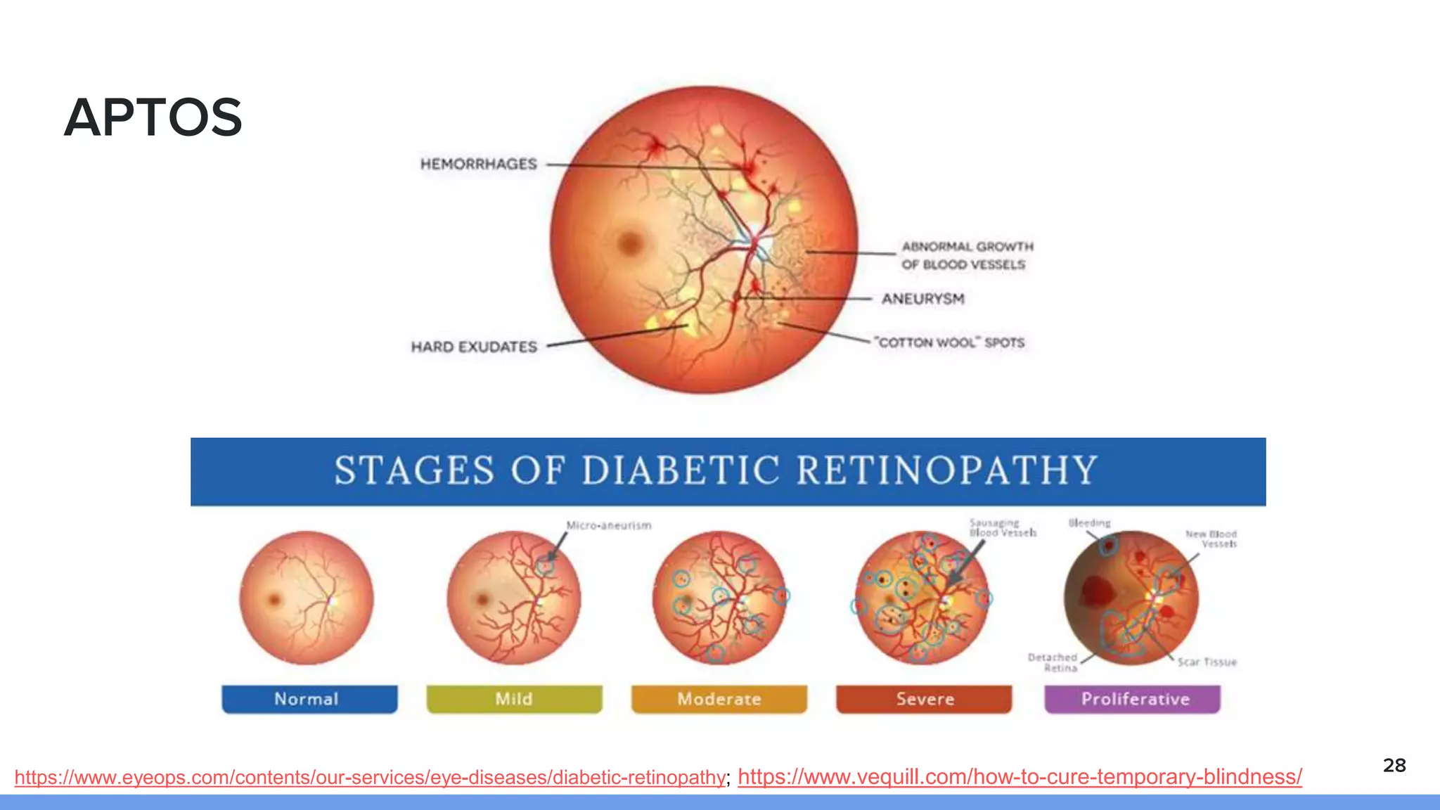 APTOS
28
https://www.eyeops.com/contents/our-services/eye-diseases/diabetic-retinopathy; https://www.vequill.com/how-to-cure-temporary-blindness/
 
