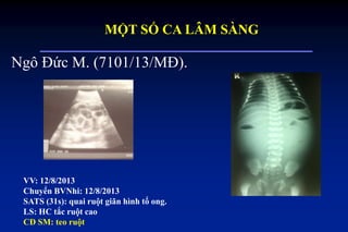 Ngô Đức M. (7101/13/MĐ).
VV: 12/8/2013
Chuyển BVNhi: 12/8/2013
SATS (31s): quai ruột giãn hình tổ ong.
LS: HC tắc ruột cao
CĐ SM: teo ruột
MỘT SỐ CA LÂM SÀNG
 