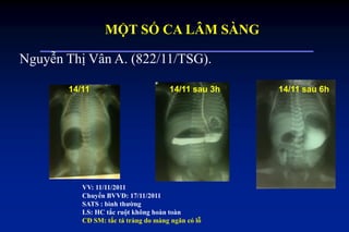 VV: 11/11/2011
Chuyển BVVĐ: 17/11/2011
SATS : bình thƣờng
LS: HC tắc ruột không hoàn toàn
CĐ SM: tắc tá tràng do màng ngăn có lỗ
Nguyễn Thị Vân A. (822/11/TSG).
14/11 14/11 sau 3h 14/11 sau 6h
MỘT SỐ CA LÂM SÀNG
 