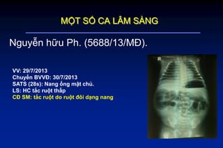 Nguyễn hữu Ph. (5688/13/MĐ).
VV: 29/7/2013
Chuyển BVVĐ: 30/7/2013
SATS (28s): Nang ống mật chủ.
LS: HC tắc ruột thấp
CĐ SM: tắc ruột do ruột đôi dạng nang
MỘT SỐ CA LÂM SÀNG
 