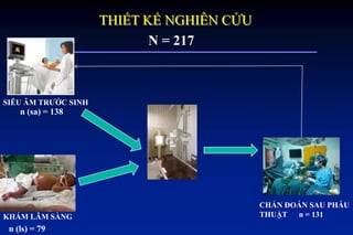 THIẾT KẾ NGHIÊN CỨU
SIÊU ÂM TRƢỚC SINH
n (sa) = 138
KHÁM LÂM SÀNG
n (ls) = 79
N = 217
CHẨN ĐOÁN SAU PHẪU
THUẬT n = 131
 