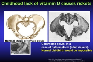 Childhood lack of vitamin D causes rickets

Normal shape of female pelvis

Contracted pelvis, in a
case of osteomalacia (adult rickets).
Normal childbirth would be impossible.
Vieth 2001. Nutritional Aspects of Osteoporosis, Chapter 17,
ed P Burckhardt, RP Heaney, B Dawson-Hughes; Academic Press

 