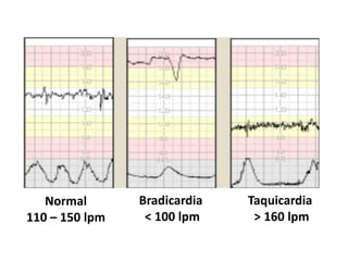Normal
110 – 150 lpm
Bradicardia
< 100 lpm
Taquicardia
> 160 lpm
 