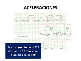 ACELERACIONES
Es un aumento de la FCF
de más de 15 lpm y que
dura más de 15 seg
 