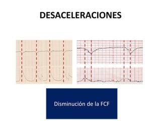 DESACELERACIONES
Disminución de la FCF
 