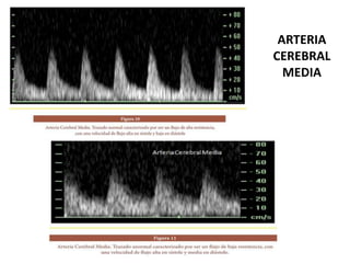 ARTERIA
CEREBRAL
MEDIA
 