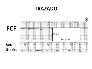 TRAZADO
FCF
Act.
Uterina
5 lpm
1 cm/min
 