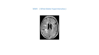 WMH ( White Matter Hyperintensities )
 