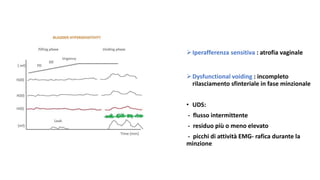 Iperafferenza sensitiva : atrofia vaginale
Dysfunctional voiding : incompleto
rilasciamento sfinteriale in fase minzionale
• UDS:
- flusso intermittente
- residuo più o meno elevato
- picchi di attività EMG- rafica durante la
minzione
 