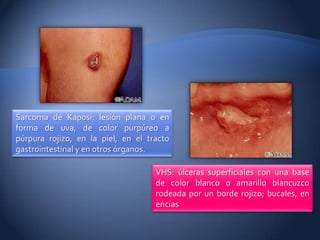 Sarcoma de Kaposi: lesión plana o en
forma de uva, de color purpúreo a
púrpura rojizo, en la piel, en el tracto
gastrointestinal y en otros órganos.

                                    VHS: úlceras superficiales con una base
                                    de color blanco o amarillo blancuzco
                                    rodeada por un borde rojizo; bucales, en
                                    encías
 