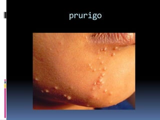 prurigo 
 
