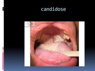 candidose 
 