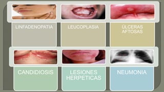 LINFADENOPATIA LEUCOPLASIA ÚLCERAS
AFTOSAS
CANDIDIOSIS LESIONES
HERPETICAS
NEUMONIA
 