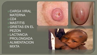 CARGA VIRAL
MATERNA
CD4
MASTITIS
GRIETAS EN EL
PEZON
LACTANCIA
PROLONGADA
ALIMENTACION
MIXTA
 