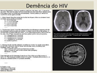 Demência do HIV
 