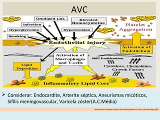 AVC
 Considerar: Endocardite, Arterite séptica, Aneurismas micóticos,
Sífilis meningovascular, Varicela zóster(A.C.Média)
Mechanisms of ischemic stroke in HIV-infected patients G. Ortiz et all, Neurology 2007
 