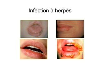 Infection à herpès
 