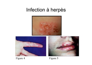 Infection à herpès
 