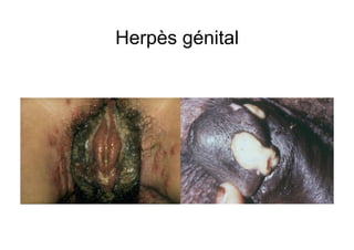 Herpès génital
 