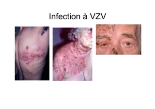 Infection à VZV
 